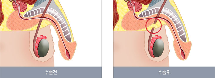 정관수술 전후 사진